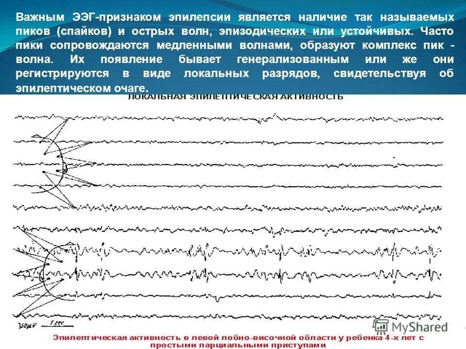 Ээг ульяновск. Миоклоническая эпилепсия ЭЭГ. ЭЭГ эпилепсия пик-волна. Региональная эпилептиформная активность ЭЭГ. ЭЭГ при юношеской миоклонической эпилепсии.