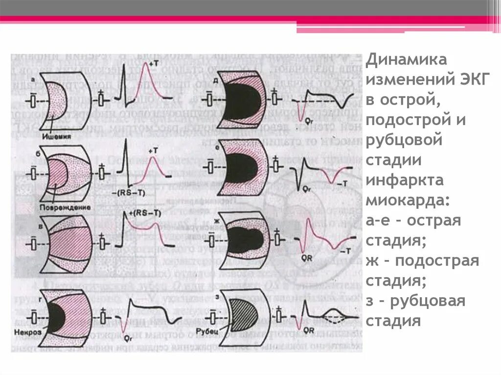 Стадии острого инфаркта миокарда. Инфаркт миокарда экг рубцевание. рубцовый инфаркт миокарда экг. динамика изменений экг при инфаркте миокарда. рубцовая стадия инфаркта миокарда на экг.