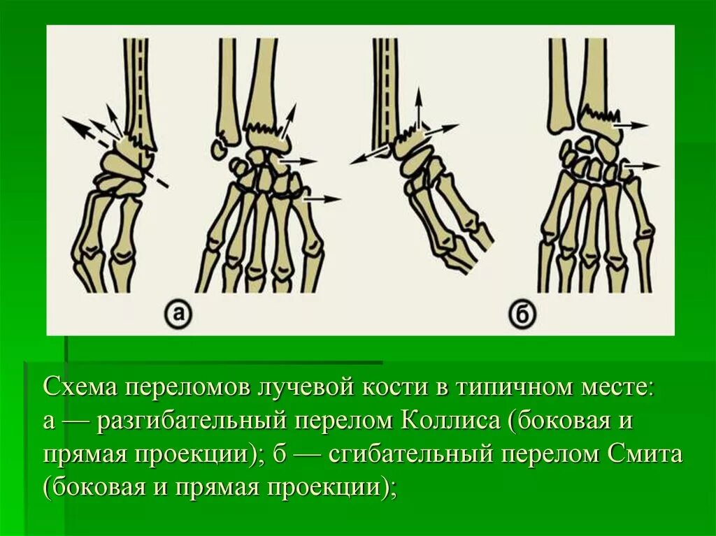 Диагноз перелома лучевой кости. Перелом медицинской кости предплечья. Перелом лучевой кости в типичном месте. Перелом лучевой кости в типипичном месте. Перелом лучевой кости в типигном место.