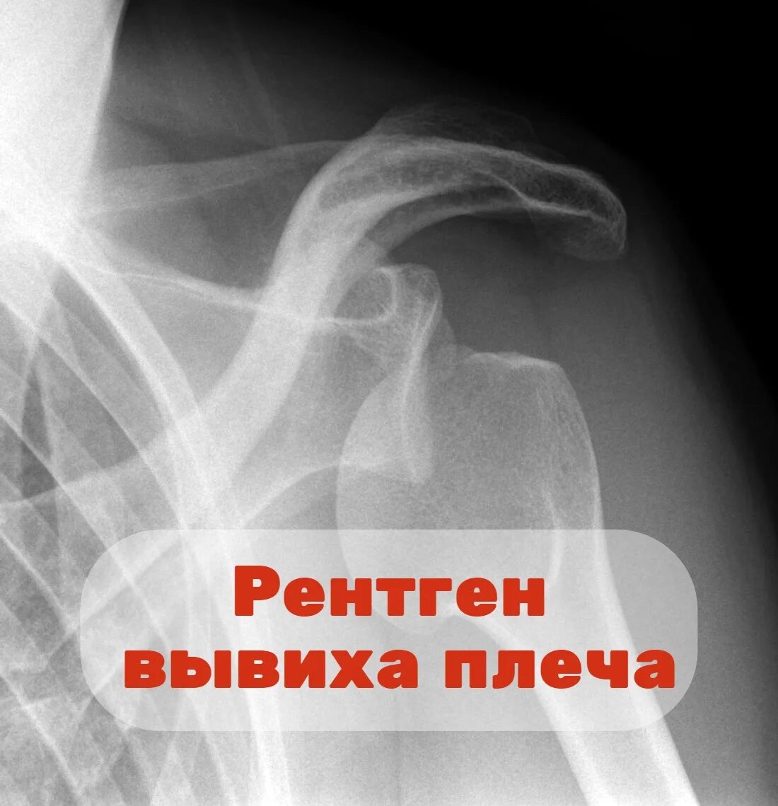 Как выглядит подвывих. Подвывих плечевого сустава рентген. подвывих плеча рентген. подвывих вывих плечевого сустава рентген. передний вывих плечевого сустава рентген.