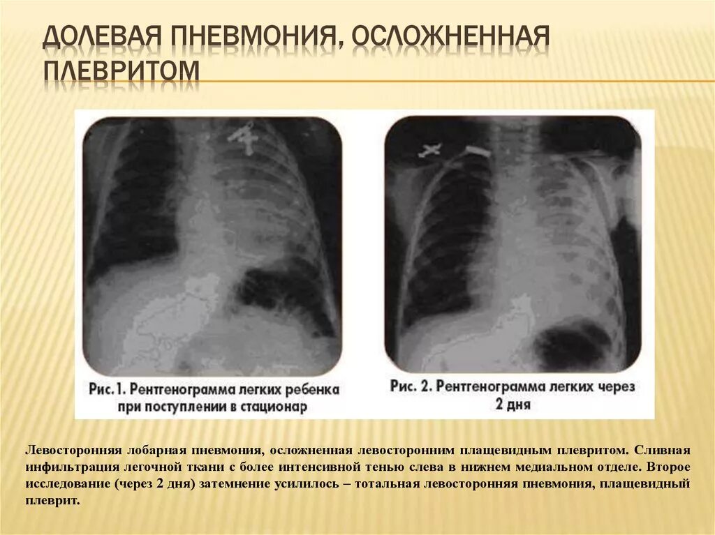 Односторонняя пневмония. Плевральные осложнения