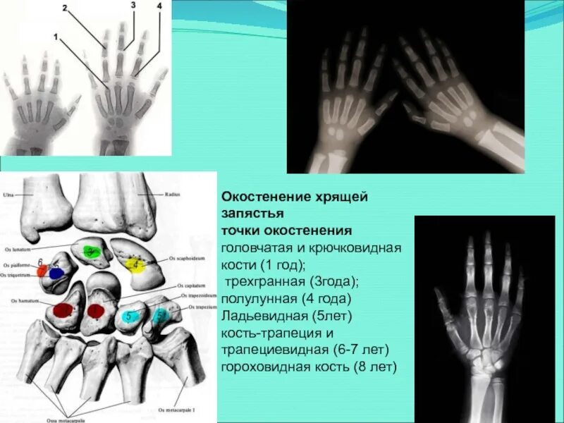 Образование лучезапястного сустава