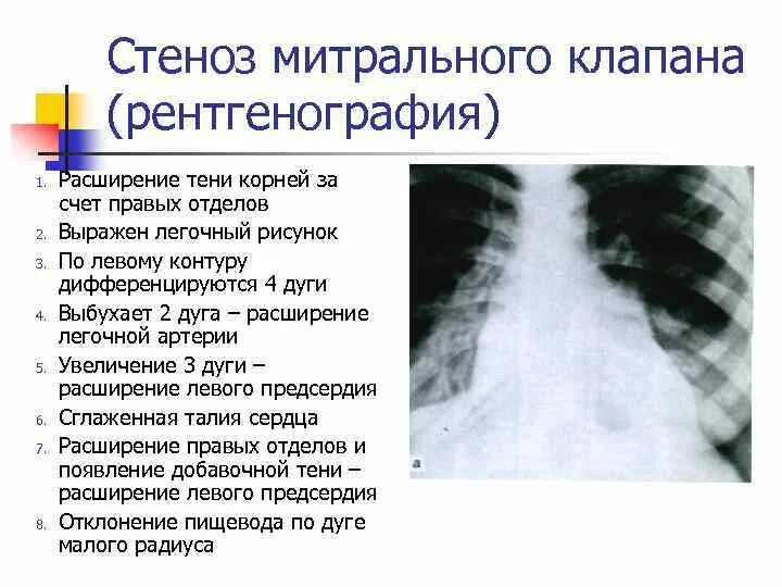 Ментальный клапан
