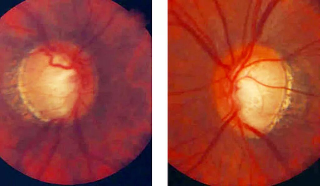 Зрительный нерв при глаукоме. Неоваскулярная закрытоугольная глаукома. Экскавация зрительного нерва при глаукоме.