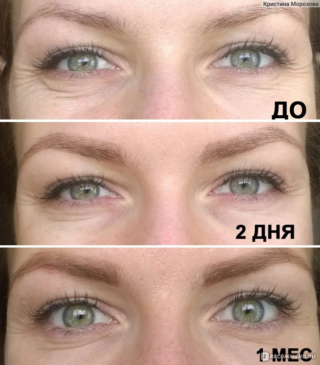 Ксеомин отзывы до и после One identical twin, 38, had Botox for 20 years the other didn't. Who do YOU th