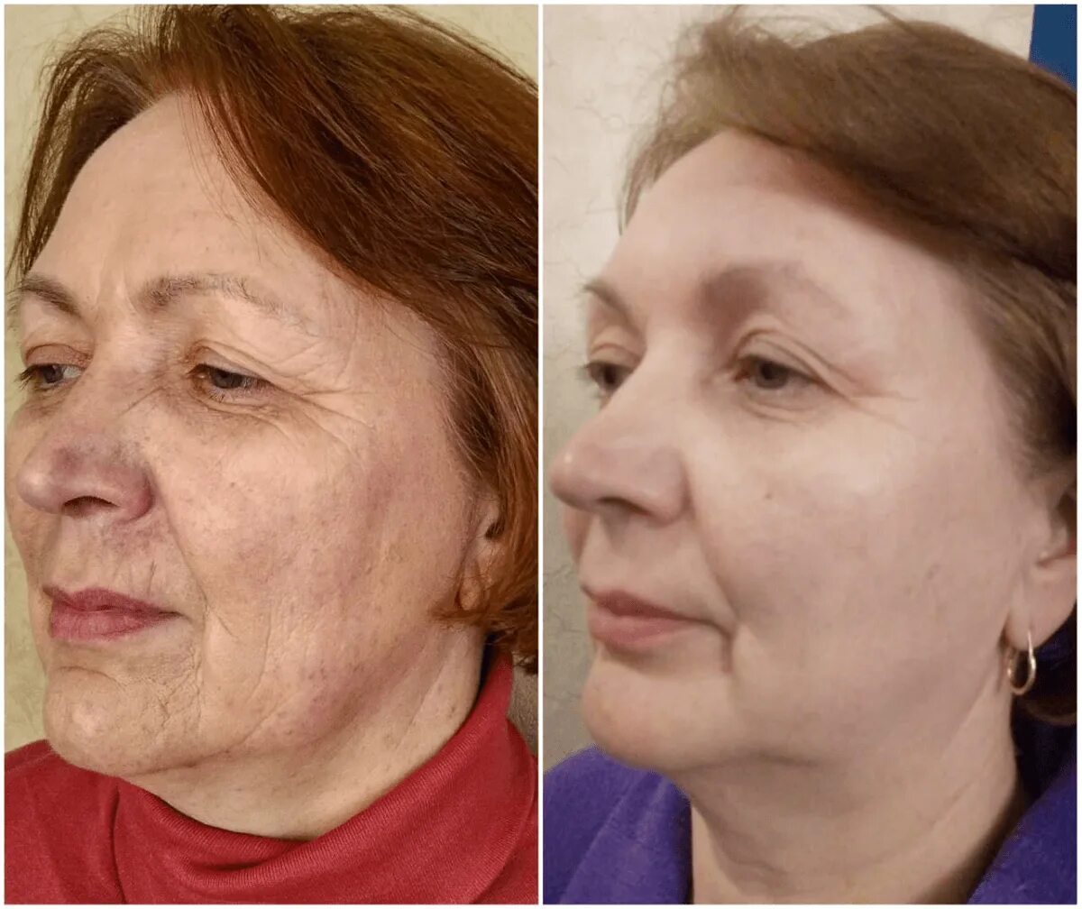 Уколы красоты для лица после 60 лет. Косметическая процедура после 60 лет. Фейслифтинг лица и шеи. Морщины на лице. Пластика лица после 60.