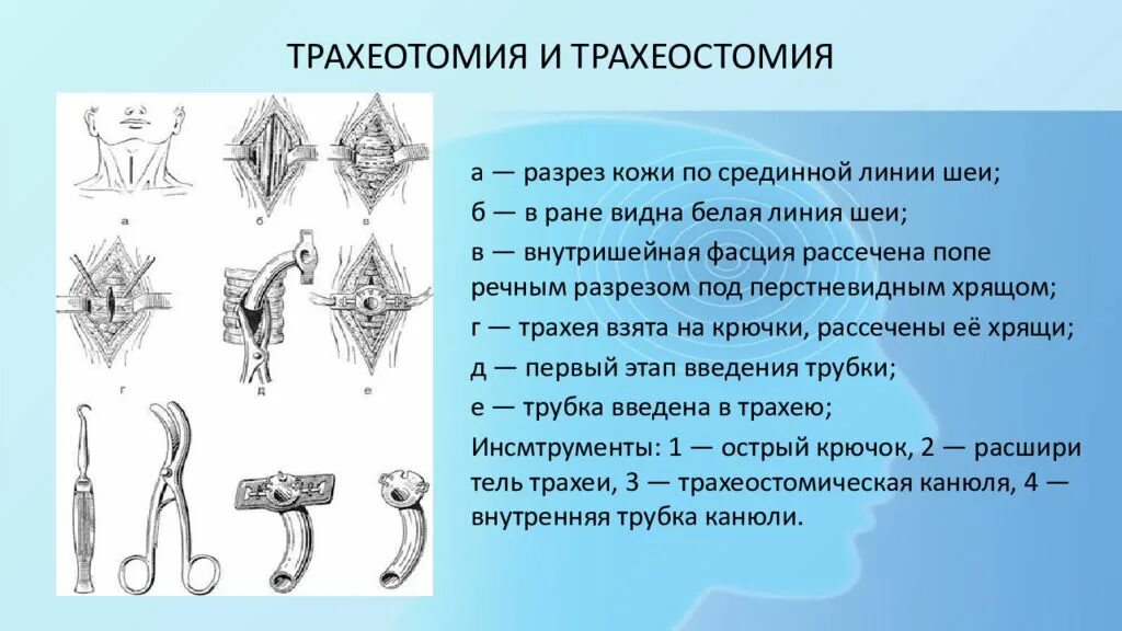 Продольная и поперечная трахеостомия. Трахеостомия оперативная хирургия. Верхняя трахеостомия оперативная хирургия. Верхняя трахеостомия оперативная хирургия. Трахеостомия проекция.