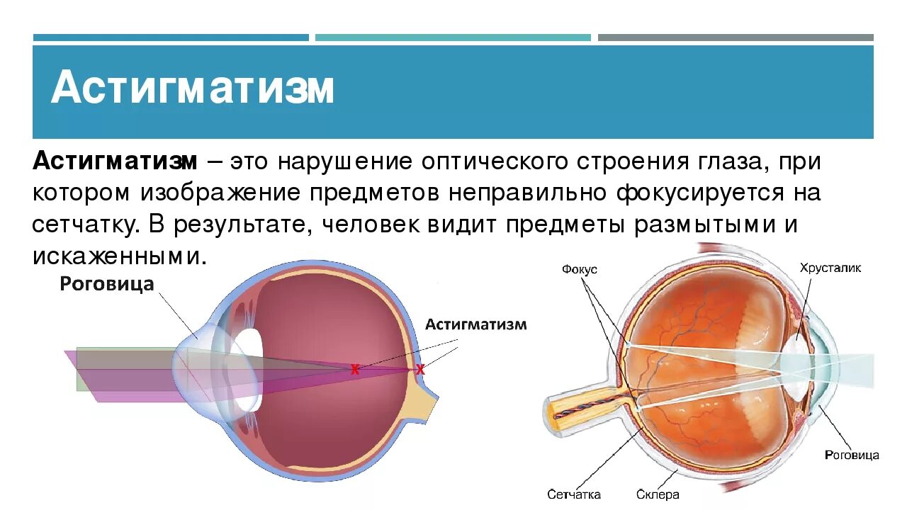 К оптической системе глаза относятся роговица хрусталик. Нарушение зрения таблица астигматизм. Строение астигматического глаза. Глаз при астигматизме схема. Строение глаза астигматизм.