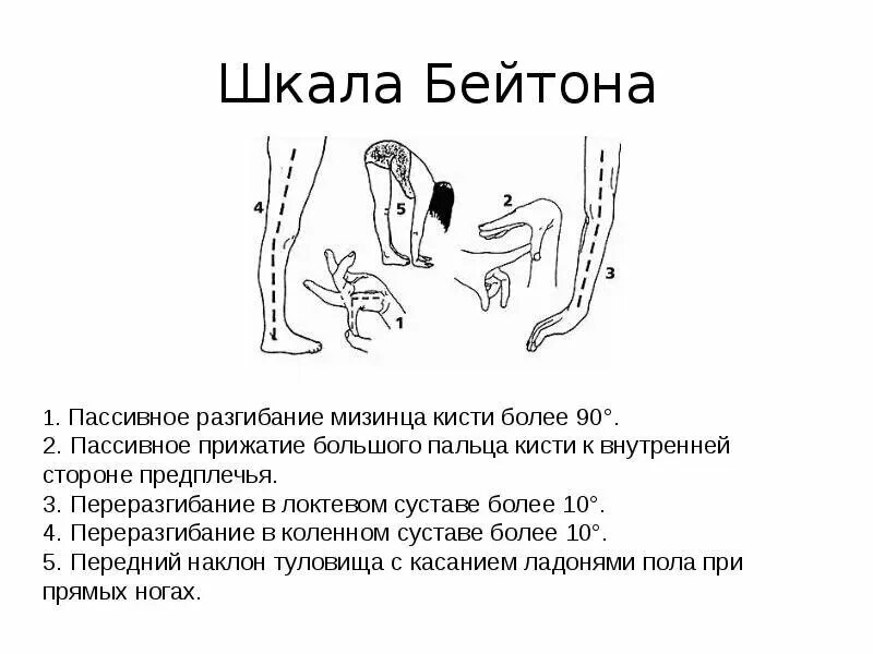 синдром гипермобильности суставов тест бейтона. дисплазия соединительной ткани марфана. упражнения при гипермобильности суставов у взрослых. комплекс упражнений на гибкость. подвижность суставов детей.
