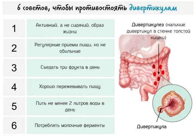 Диета при дивертикулёзе Толстого кишечника. Дивертикулит толстой кишки диета. Дивертикулит толстой кишки диета питание. Диета при дивертикулите сигмовидной.