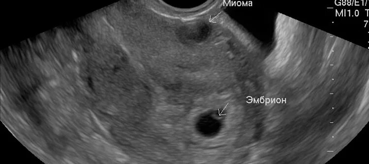 Матка увеличена до 6 недель. Шеечная миома матки УЗИ. Субмукозная миома матки УЗИ.