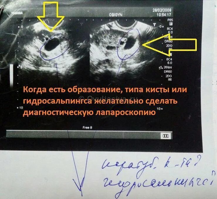 Можно забеременеть при непроходимости труб