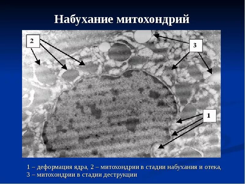 Необратимые изменения клетки. Набухание митохондрий при гипоксии. обратимые изменения митохондрий. повреждение митохондрий при гипоксии. набухание и конденсация митохондрий гепатоцита.