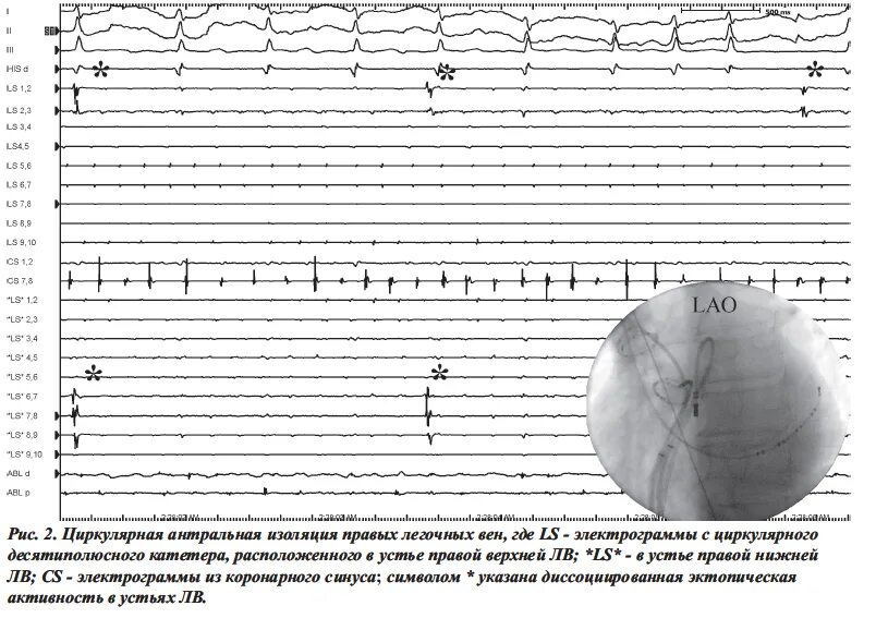 Транссептальная пункция. АВРТ аритмология. Coumel Arrhythmology.