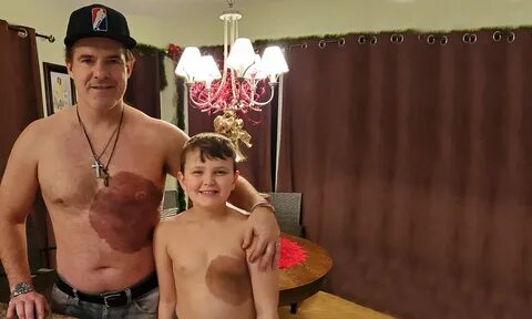 Dad Endures 30-Hour Tattoo, Surprises Son With Replica Birthmark to Boost H...