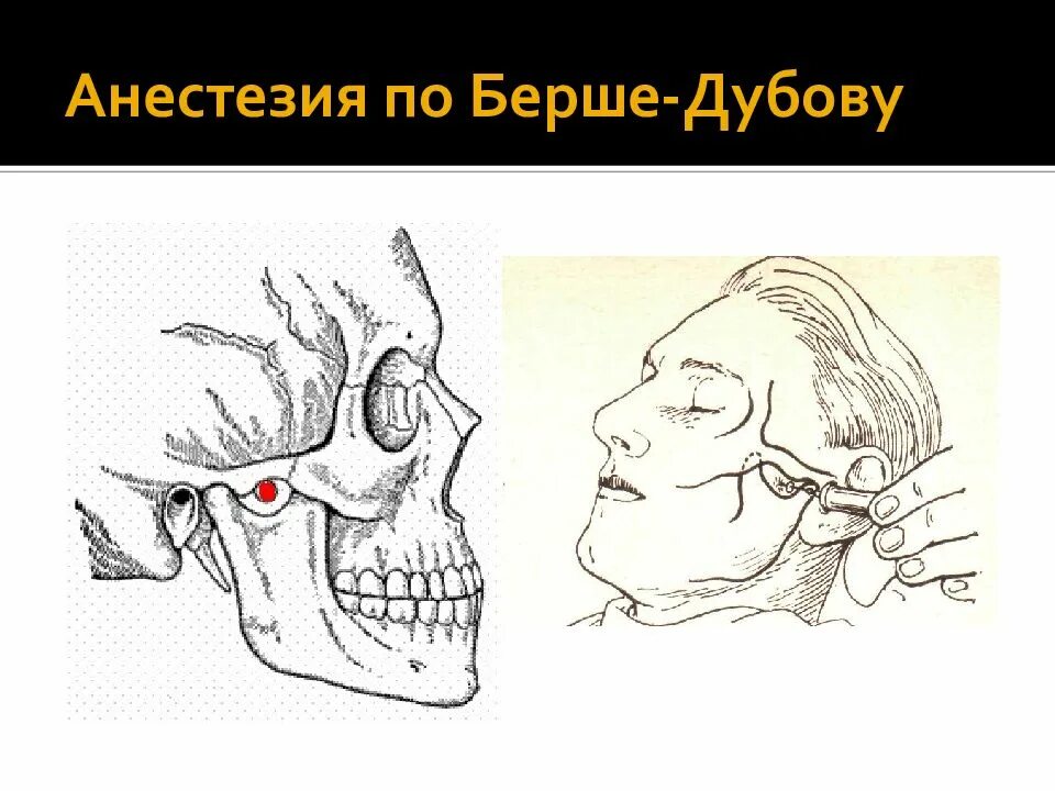 Блокада тройничного. Анестезия по Берше дубову. Стволовая анестезия по Берше-дубову-Уварову. Стволовая анестезия подскуловой метод. Блокада по Берше дубову Уварову.