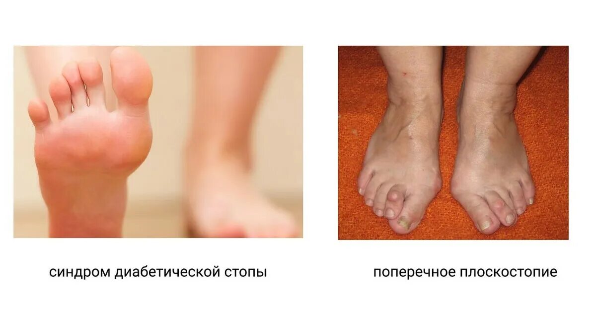 Метатарзалгия мортона блокада. Метатарзалгия стопы. Метатарзалгия правой стопы. Неврома метатарзалгия. Межпальцевая неврома мортона.