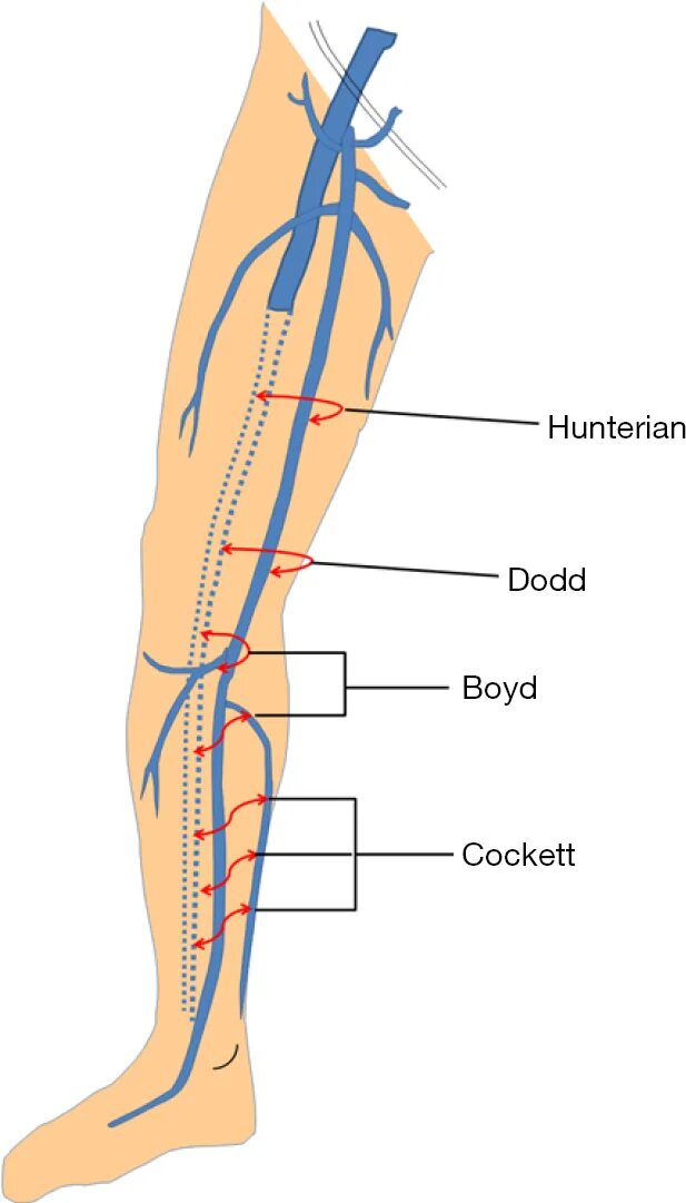 Перфорантные вены нижних конечностей. Перфорантные вены нижних конечностей анатомия. Перфорантная Вена Додда.