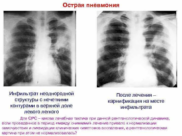 Изменение в верхнем легком. Инфильтрация и пневмония рентген. Инфильтративная пневмония рентген. Пневмонический инфильтрат легкого. Пневмоническая инфильтрация кт.