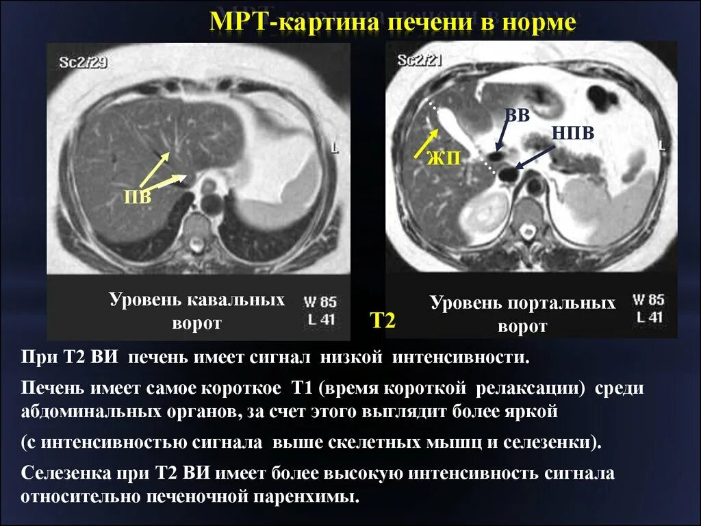 Магнитно-резонансная томография печени. Кт печени норма. Кт норма печень