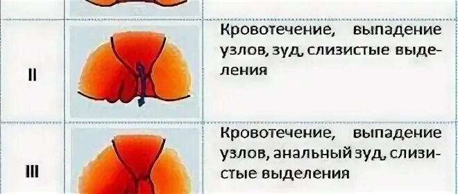 Почему геморрой при месячных. Стадии геморроя в таблице. выпадение геморроидальных узлов при беременности. геморрой при беременности 3 триместр. причины геморроя у беременных.
