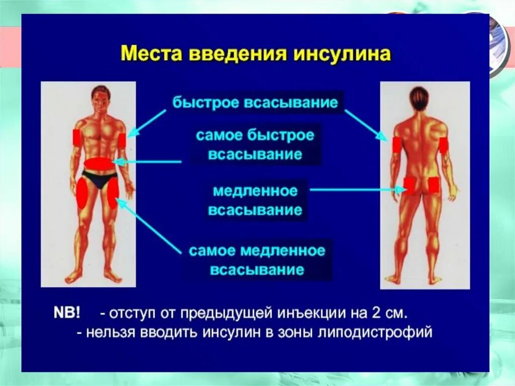 Введение инсулина при сахарном диабете. Зоны введения инсулина диабетикам. Мечта введения инсулина. Мечта выкдения инсулина. Места инъекций инсулина.