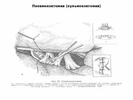 Пульмонэктомия