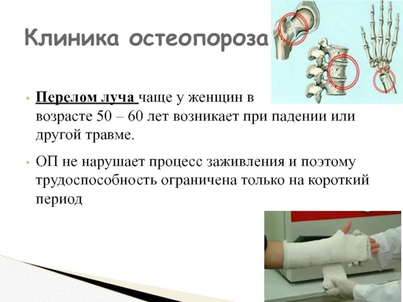 Остеопороз кости после перелома. Диффузная остеопения. Частые переломы при остеопорозе. Осложнения при остеопорозе. Костная ткань остеопороз.