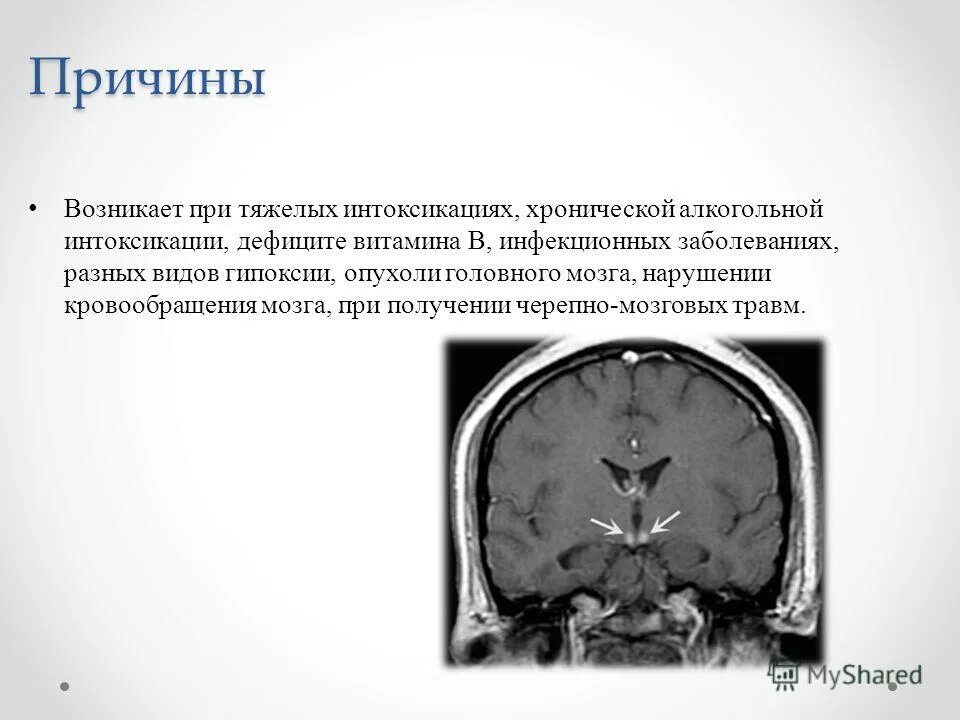 Оттек мозга. Отек мозга при интоксикации. Смерть от отека головного мозга. Отёк мозга при алкогольной интоксикации.