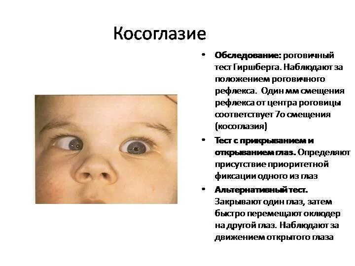 Косоглазие симптомы. Угол косоглазия 15 градусов. Косоглазие 15 градусов у ребенка. Угол косоглазия по Гиршбергу.