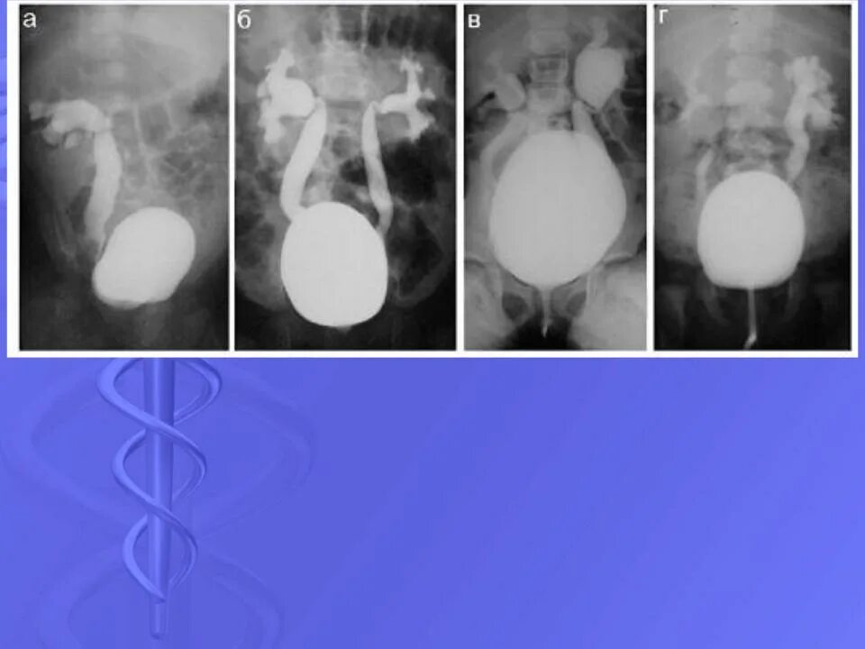 Рефлюкс 2 степени. Микционная цистография рефлюкс. Микционная цистоуретрография пузырно-мочеточниковый рефлюкс. Мегауретер цистография. Микционная цистоуретрография мегауретер.