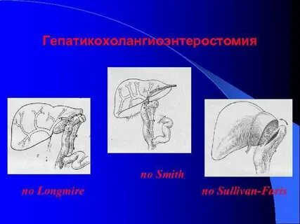 Операция бергмана