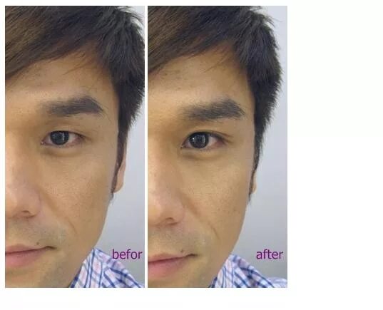 Операция на двойное веко в корее. Изменить форму глаз макияжем. Можно ли изменить разрез глаза. Сангапури в корее. Изменить разрез глаза операция.