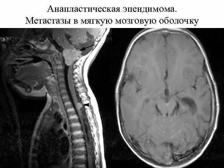 Эпендимома спинного мозга мрт. Эпендимома 4 желудочка мрт. Анапластическая эпендимома IV желудочка.