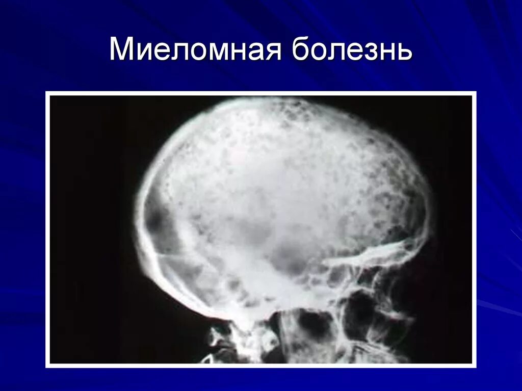 Множественная миелома рентген черепа. Миеломная болезнь костей черепа. Рентген черепа при миеломной болезни. Миеломная болезнь рентген черепа.