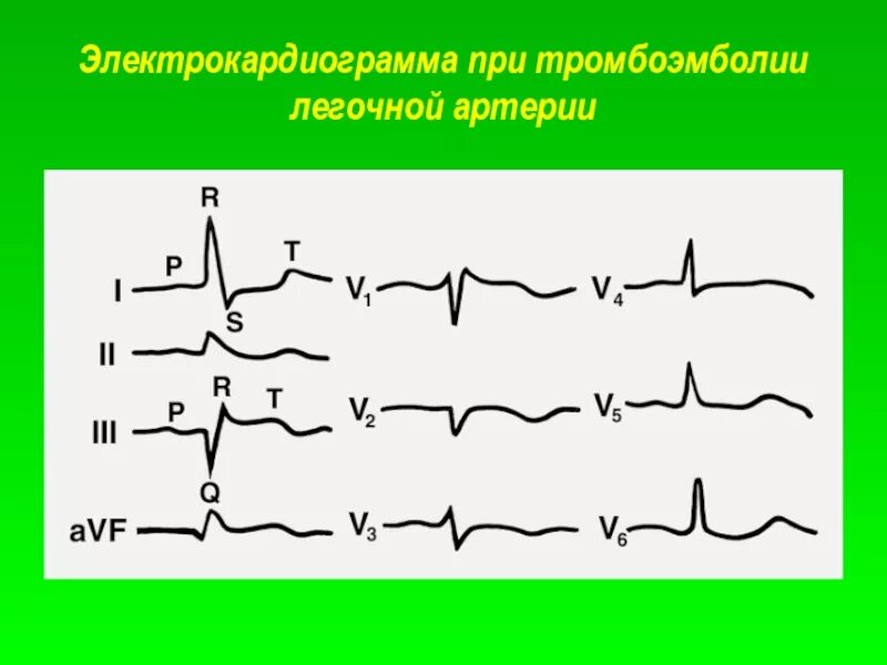 Тромбоэмболия легочной артерии экг. ЭКГ при тромбоэмболии легочной. Тэла ЭКГ s1 q3. Тромбоэмболия легочной артерии на ЭКГ. ЭКГ при тромбоэмболии легочной артерии.