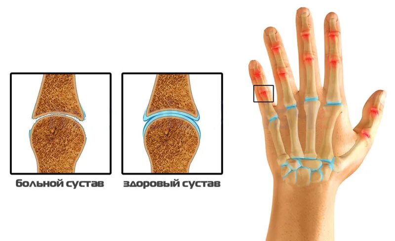 Почему хрустит запястье