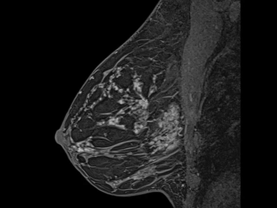 Маммография ростов на дону. Склерозирующий аденоз маммография. Магнитно резонансная томография молочной железы. Липома молочной железы рентген.