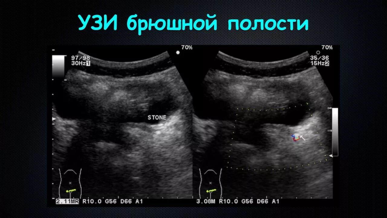 Узи полные органов. Ультразвуковое исследование органов брюшной полости (УЗИ). Ультразвуковое исследование органов брюшной полости комплексное. УЗИ органов полости таза брюшной. УЗИ органов брюшной полостт.