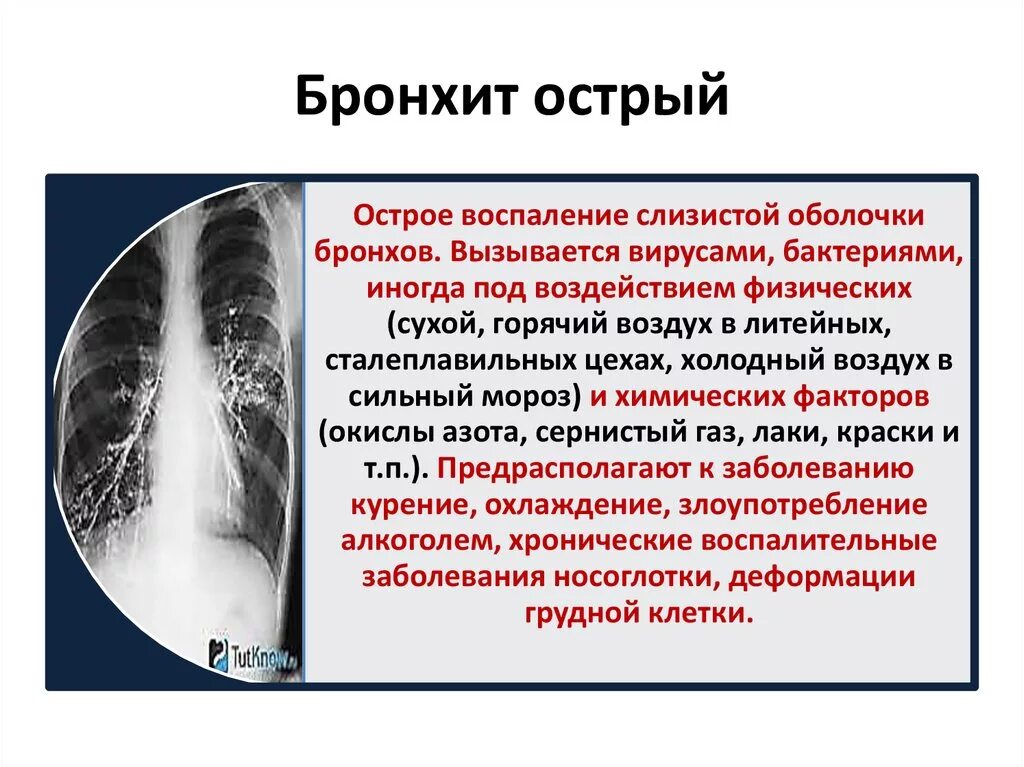 Острый обструктивный бронхит симптомы. Хронический обструктивный бронхит синдромы. Бронхит клинические рекомендации. Бронхит с обструкцией.