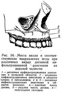 Анестезия верхней челюсти
