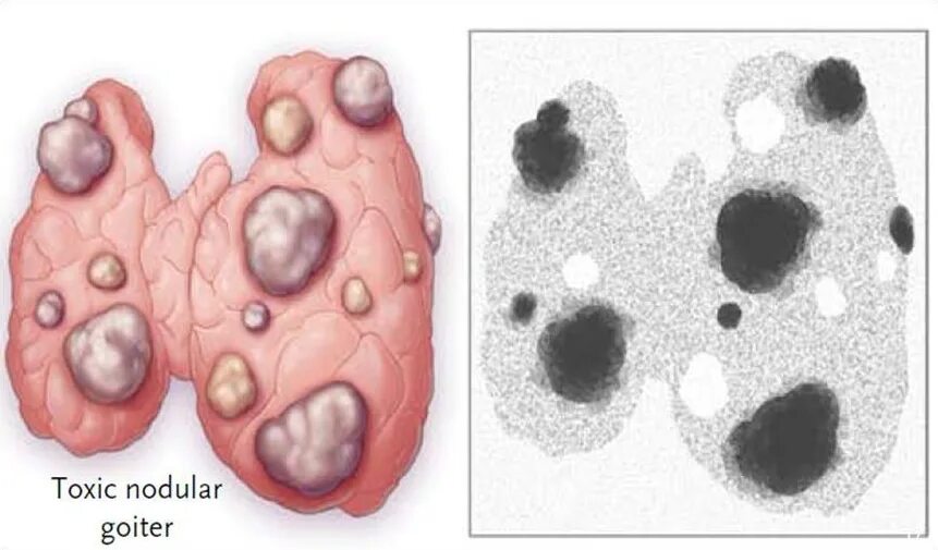 Зоб щитовидной железы диффузный диффузный многоузловой. Многоузловой токсический зоб. Узловой токсический зоб. Узловой и многоузловой токсический зоб. Диффузно многоузловой зоб