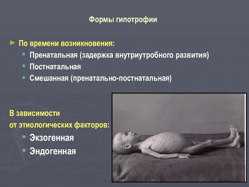 Гипотрофия. Клинические формы пренатальной гипотрофии. гипотрофия 1 степени у детей. алиментарная дистрофия. внутриутробная гипотрофия степени.