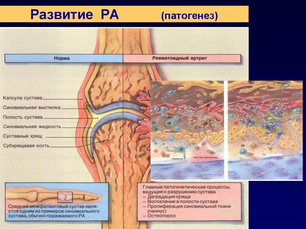 артрит схема. базисная терапия ревматоидного артрита препараты. схема ревматоидного артрита иммунология. артрит схема. артрит схема.