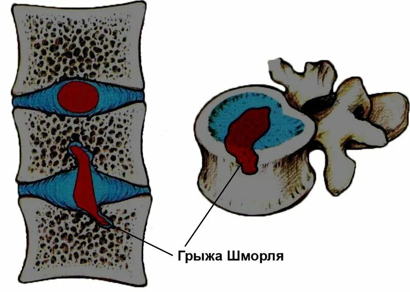 Грыжа шморля тн12. Грыжи шморля th12-l4. Большая грыжа шморля в поясничном отделе позвоночника. L1 грыжа шморля позвоночника. Единичные грыжи шморля.