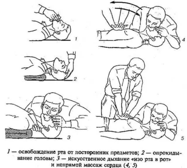 Искусственная вентиляция и непрямой массаж сердца. Схема оказания искусственного дыхания. искусственное дыхание и непрямой массаж сердца схема. алгоритм искусственного дыхания и непрямого массажа. техника ивл и непрямого массажа сердца алгоритм.