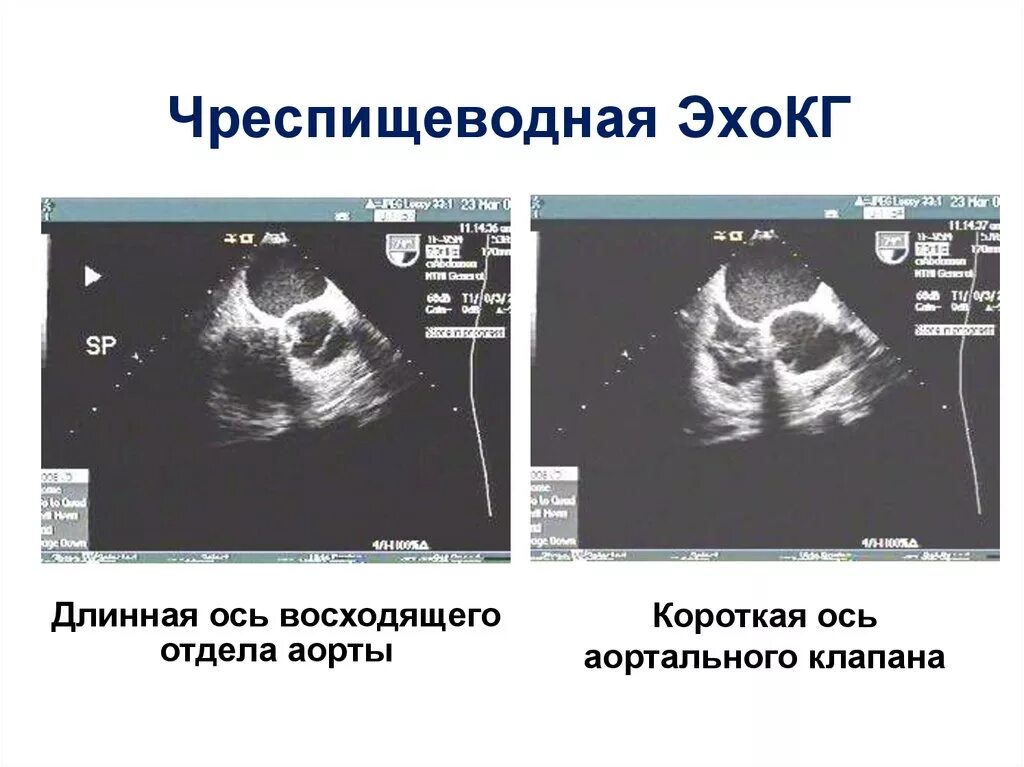 ЭХОКГ трансторакальная и чреспищеводная. Трансторакальное ЭХОКГ. Эхокардиография через пищевод. Чреспищеводная эхокар.