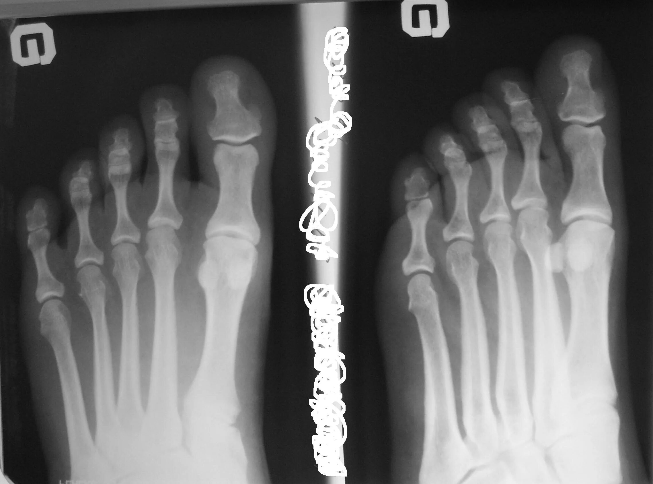 Остеохондрома ногтевой фаланги 1 пальца стопы. Перелом дистальной фаланги 1 пальца стопы рентген. Перелом 1 пальца стопы на рентгене. Перелом диафиза проксимальной фаланги. Ногтевая фаланга ноги