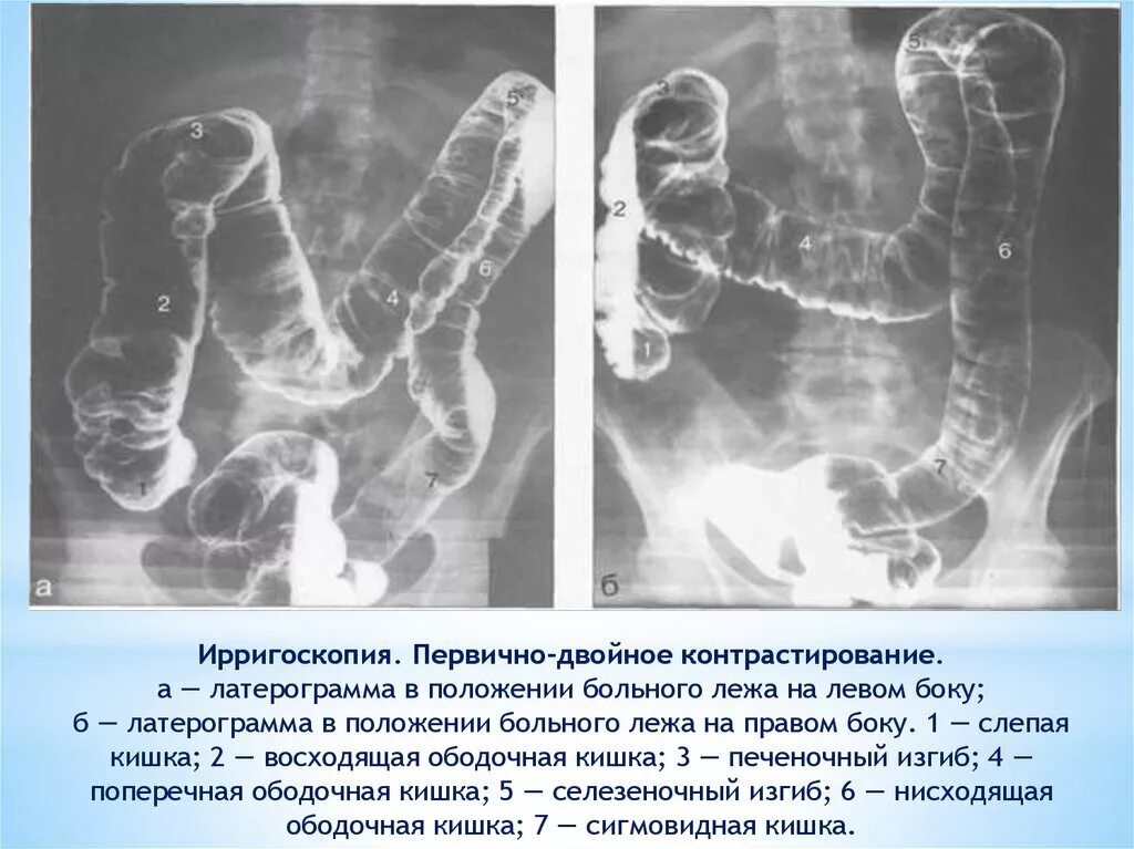 Исследование прямой и сигмовидной кишки. Ирригоскопия сигмовидной кишки. Ирригоскопия опухоль сигмовидной кишки. Двойное контрастирование Толстого кишечника. Ирригография с двойным контрастированием.