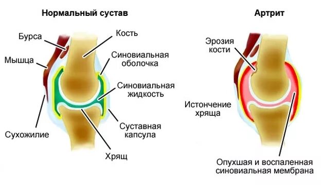 Разрыв суставной капсулы пальца. Синовиальная сумка сустава.